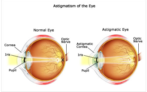 Astigmatisme